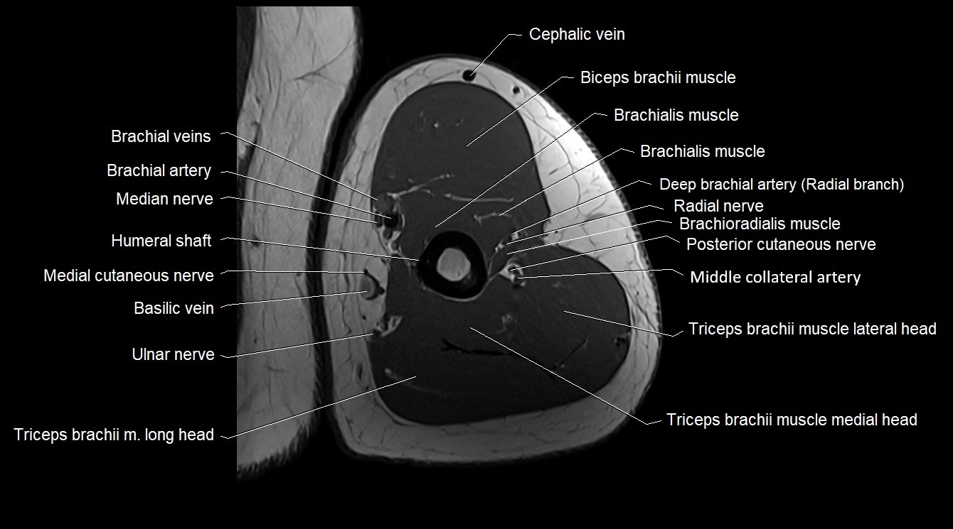 Upper arm( humerus) cross section anatomy MRI 3T axial image 40.webp